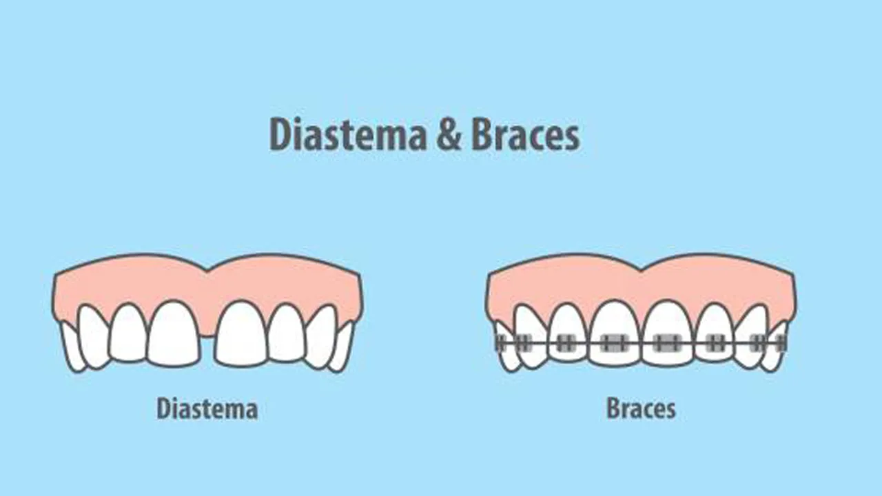 Diastema Definition