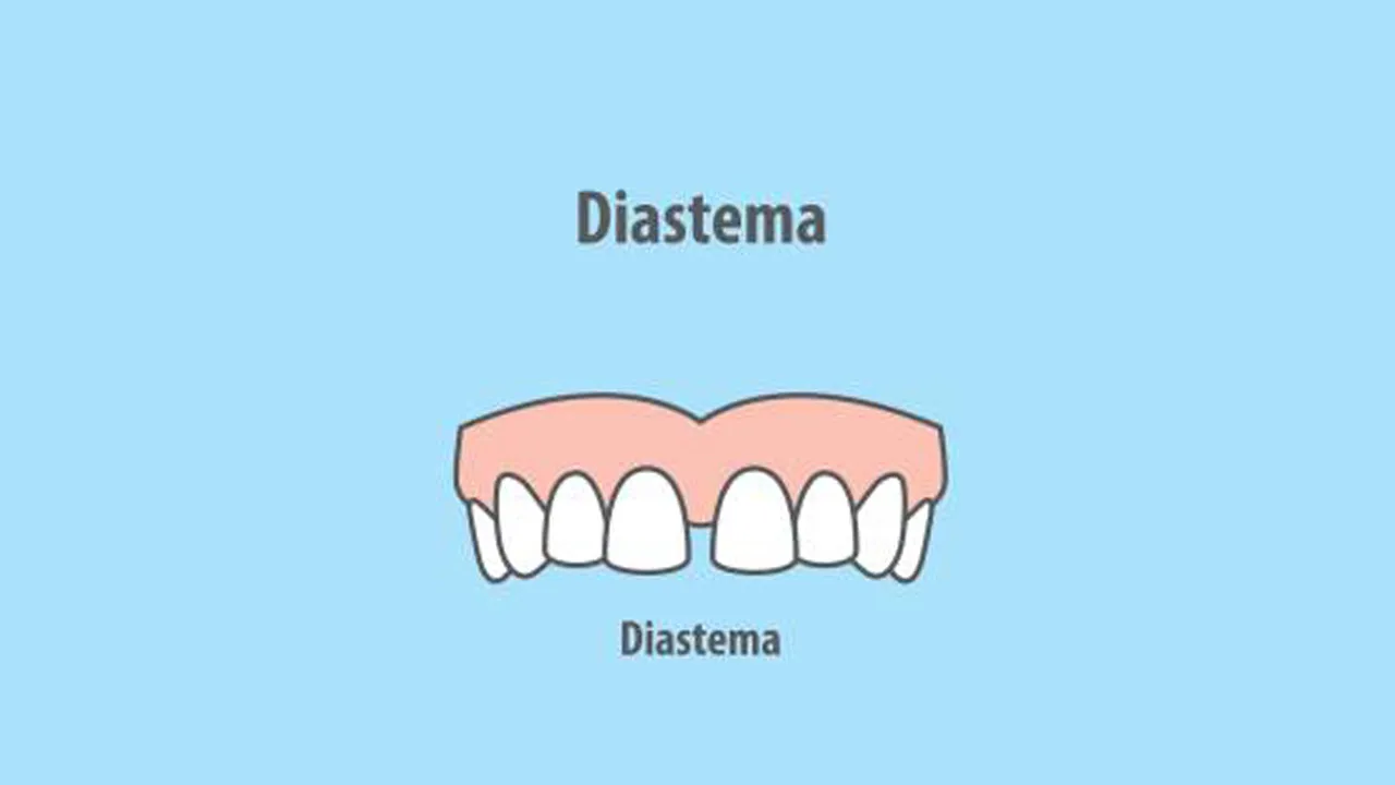 Myra Dental Centre - diastema-definition-types-causes-and-treatment