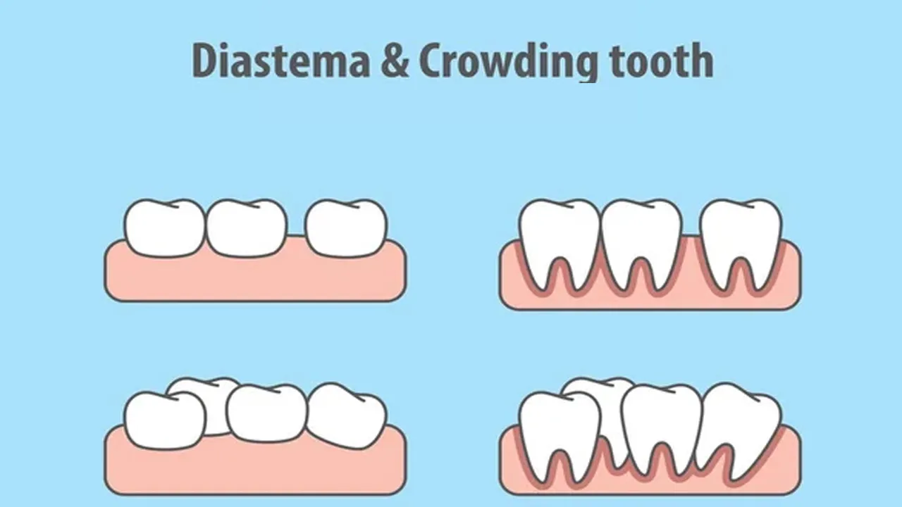 Myra Dental Centre - diastema-definition-types-causes-and-treatment
