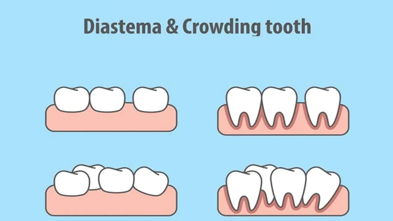 Diastema Definition