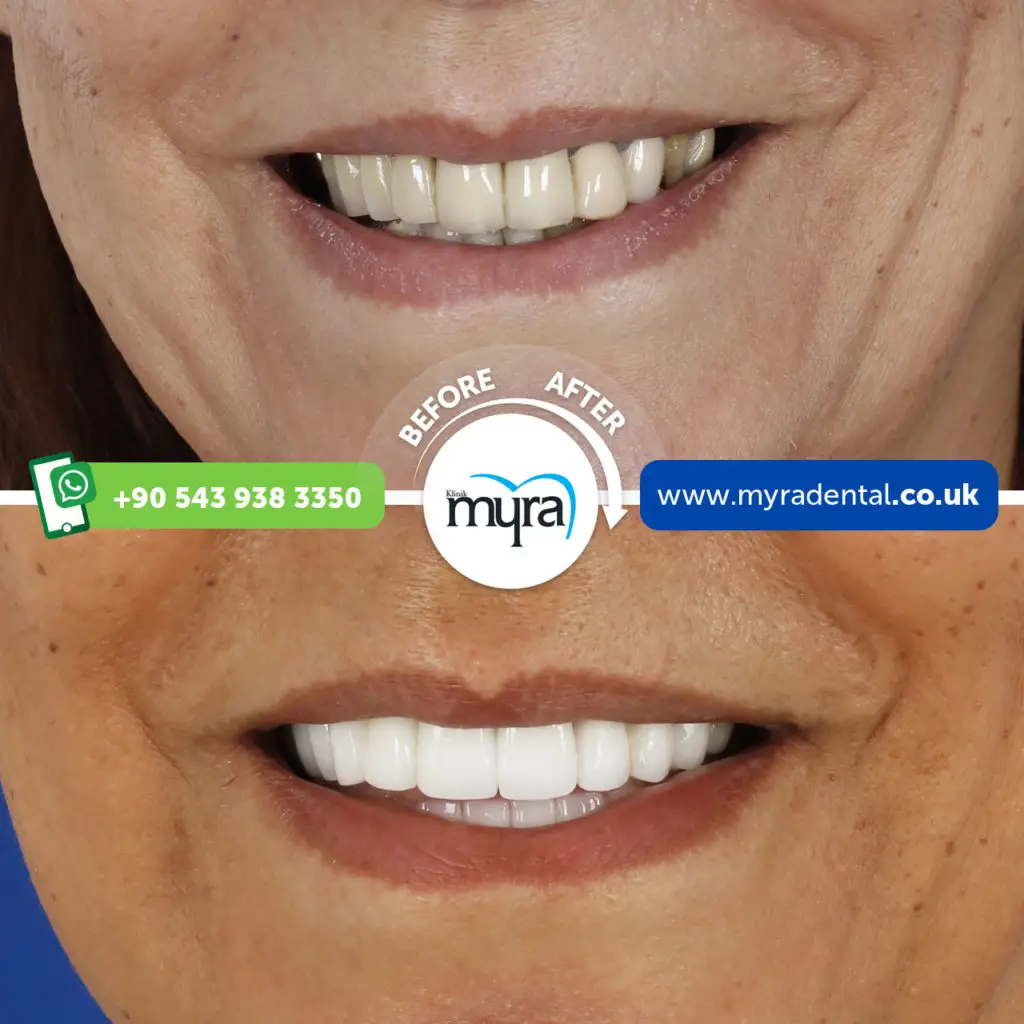 Myra Dental Centre Turkey -  full-set-of-veneers-in-turkey