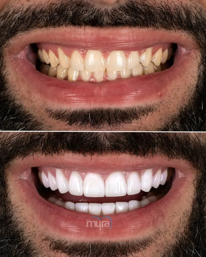 Myra Dental Centre Turkey -  full-set-of-veneers-in-turkey