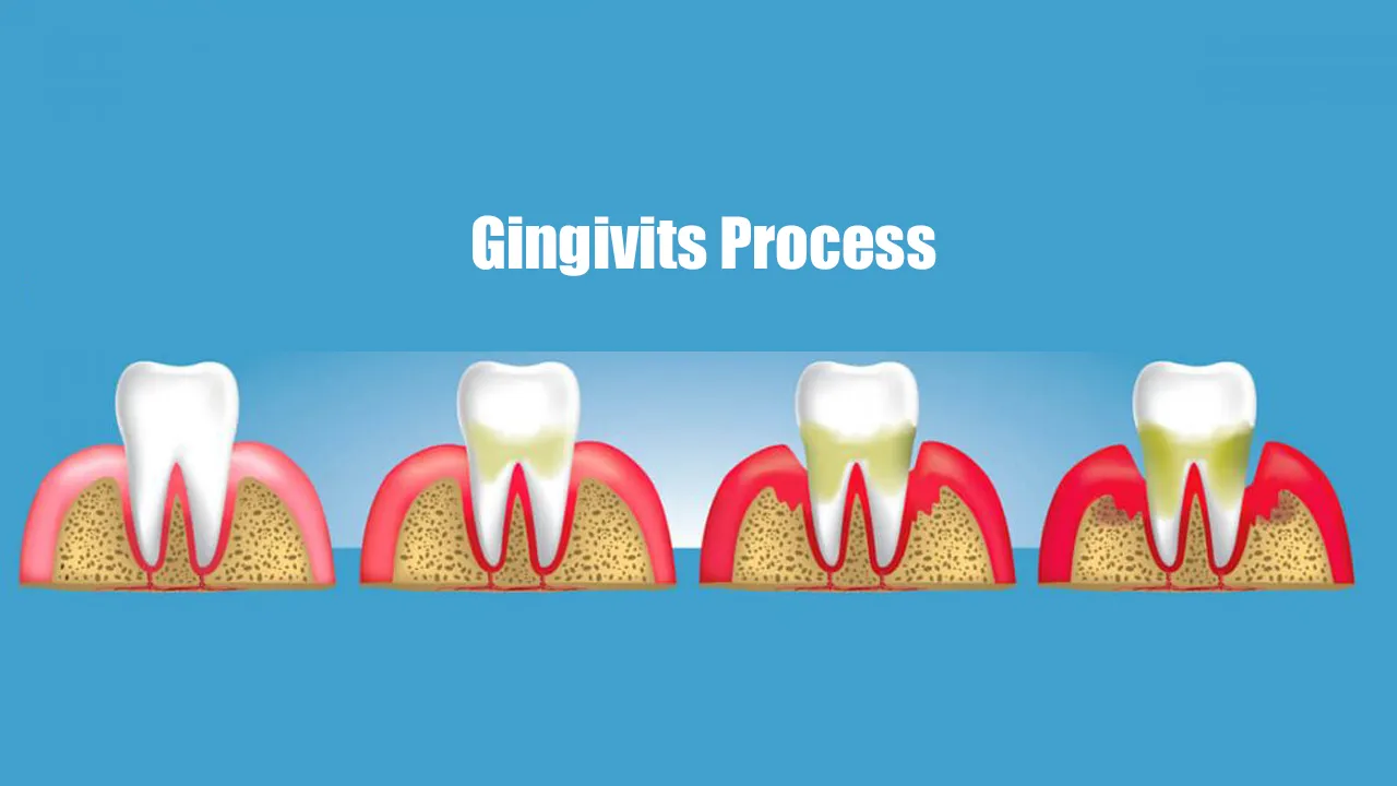 Myra Dental Centre - gingivitis-definition-types-cost-and-recovery-duration