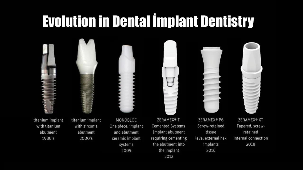 Myra Dental Centre - history-of-dental-implant