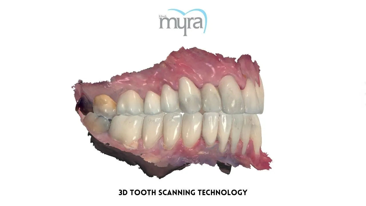 Myra Dental Centre Turkey - Comparing Veneer Costs Pros and Cons in India vs Turkey