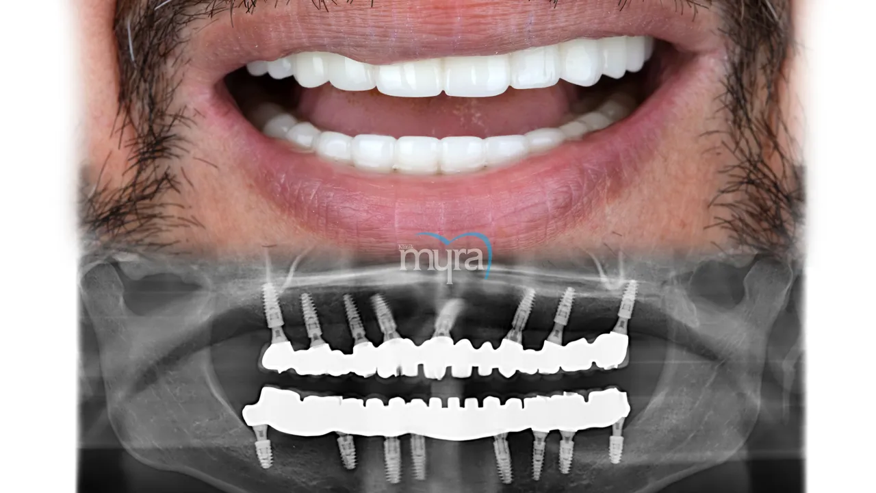 Myra Dental Centre Turkey - Required number of implants for supporting an upper denture