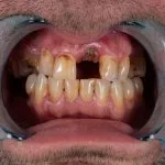 Myra Dental Centre Turkey - how-many-implants-can-you-have