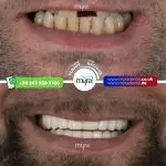 Myra Dental Centre Turkey - how-many-implants-can-you-have