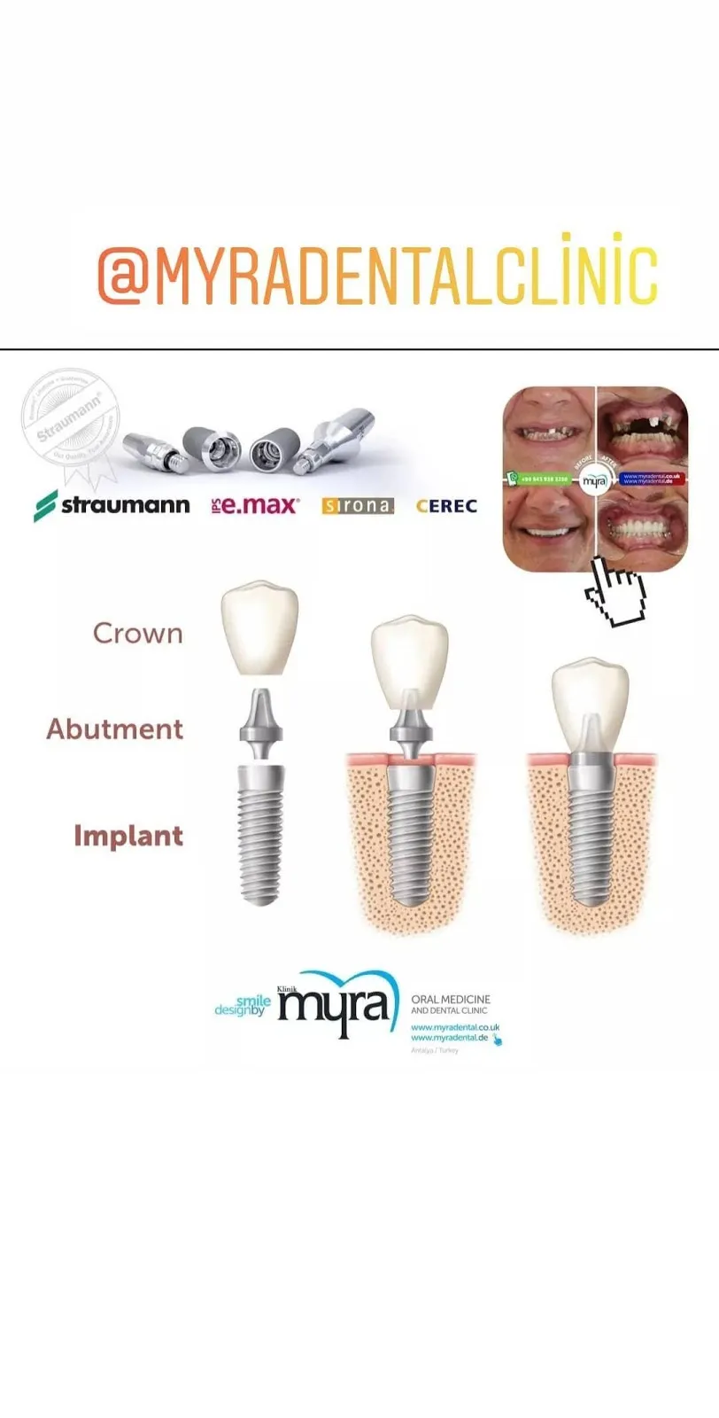 Myra Dental Centre Turkey - how-much-are-dental-implants-in-turkey