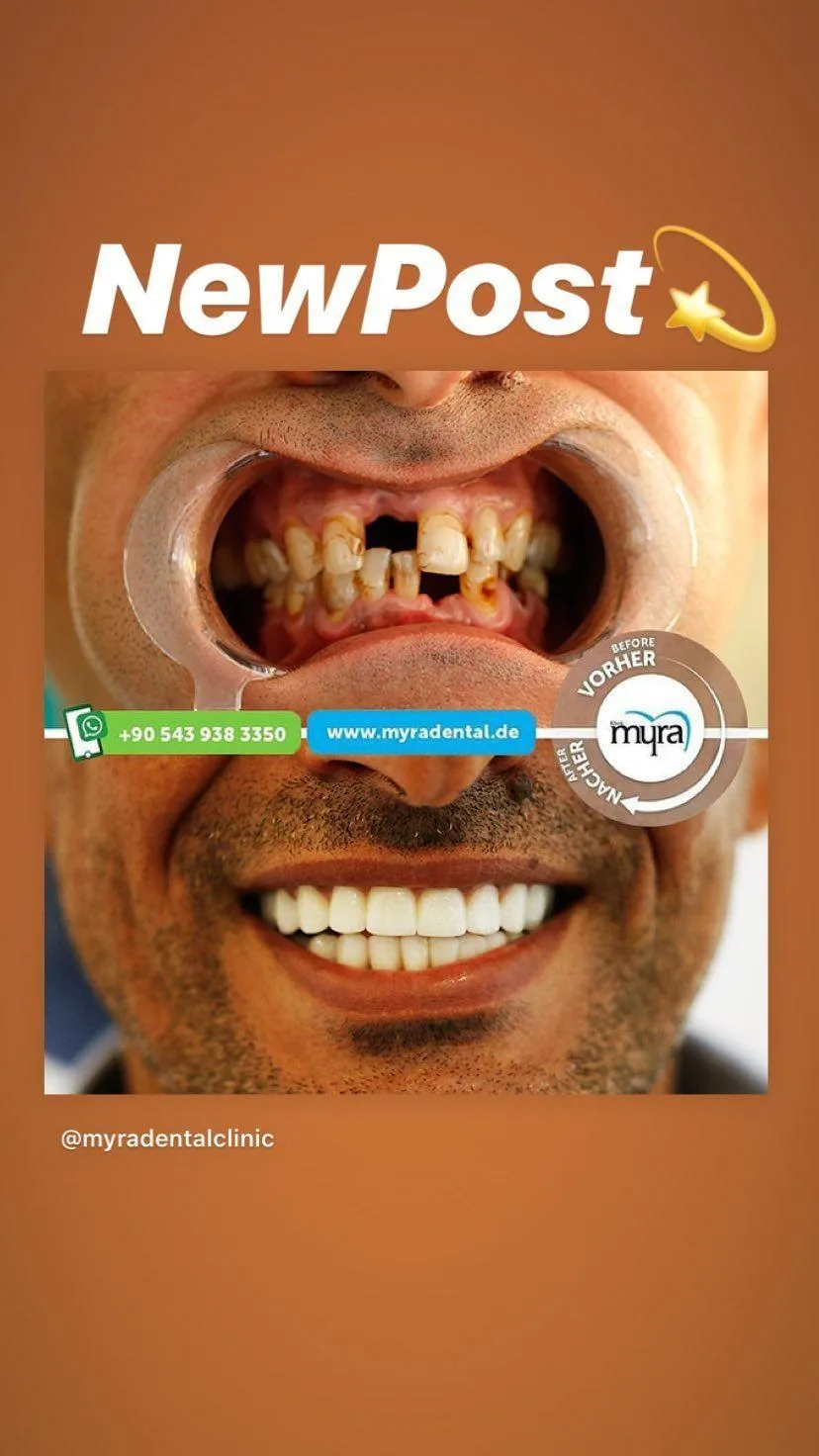 Myra Dental Centre Turkey - how-much-are-dental-implants-in-turkey