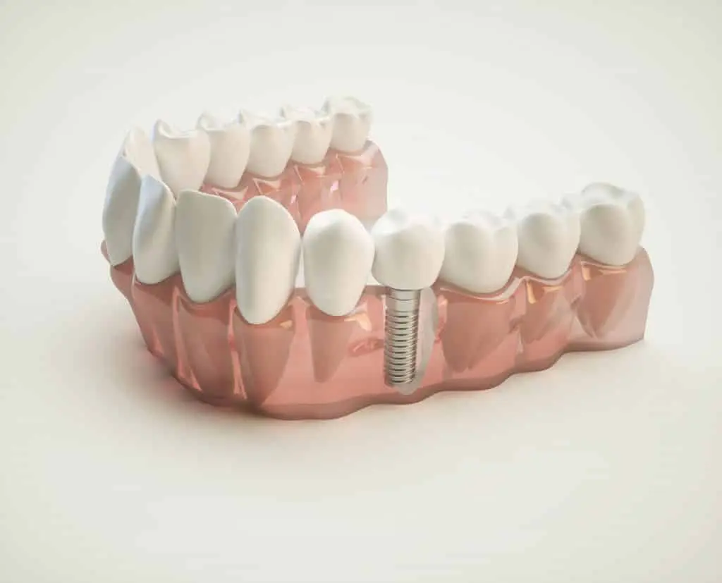 Myra Dental Centre Turkey - how-much-implants-cost-in-uk-1