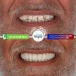 Myra Dental Centre Turkey - how-often-do-implants-need-to-be-1