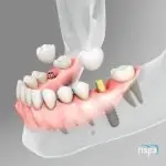 Myra Dental Centre Turkey - how-often-do-implants-need-to-be-1