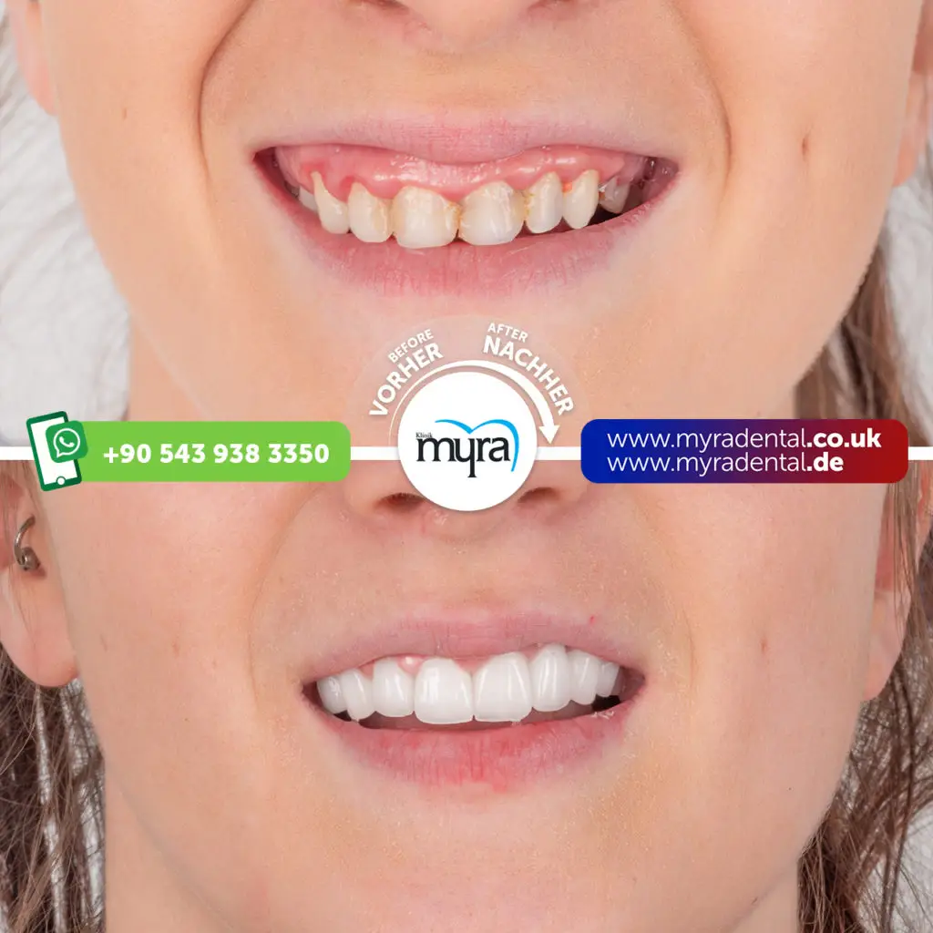 Myra Dental Centre Turkey - how-to-get-your-teeth-done-in-turkey