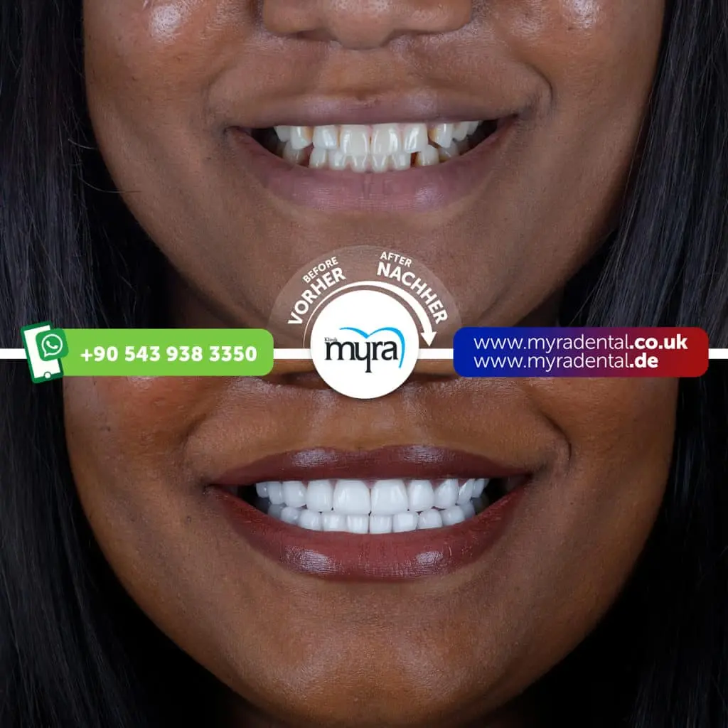 Myra Dental Centre Turkey - how-to-get-your-teeth-done-in-turkey