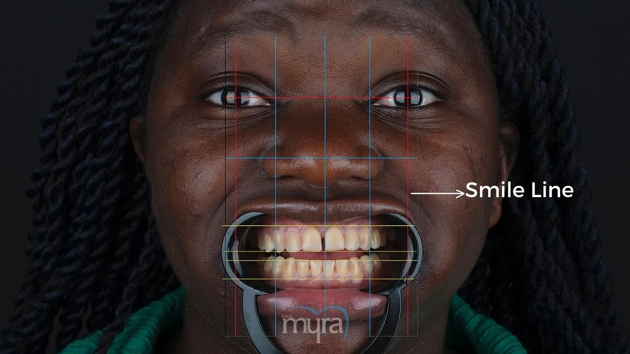 Typical number of veneers required for dental restoration