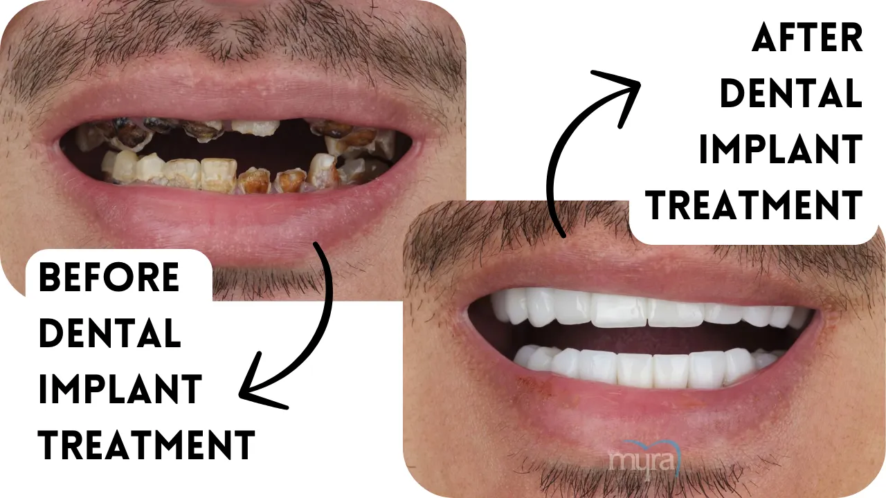 Pricing details for dental implants in the UK