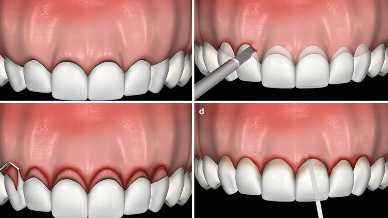 Gum Contouring Definition