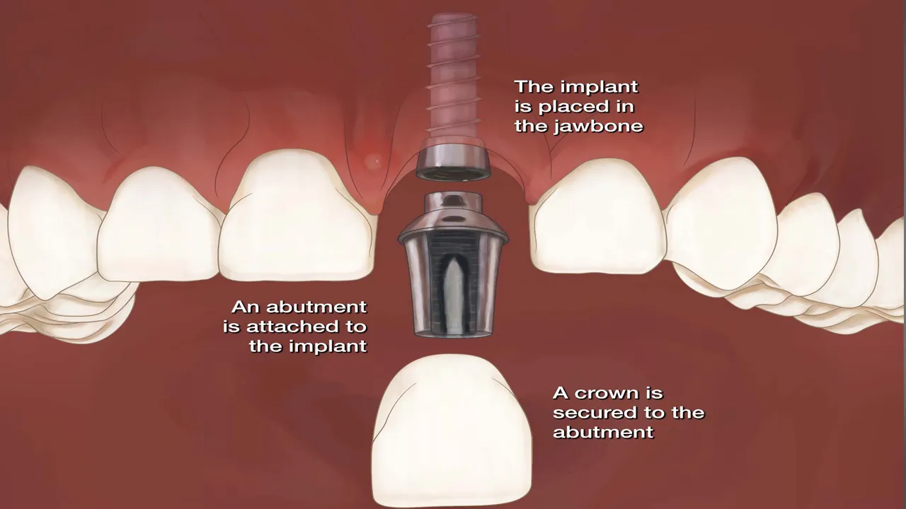 Mini Dental Implants Definition