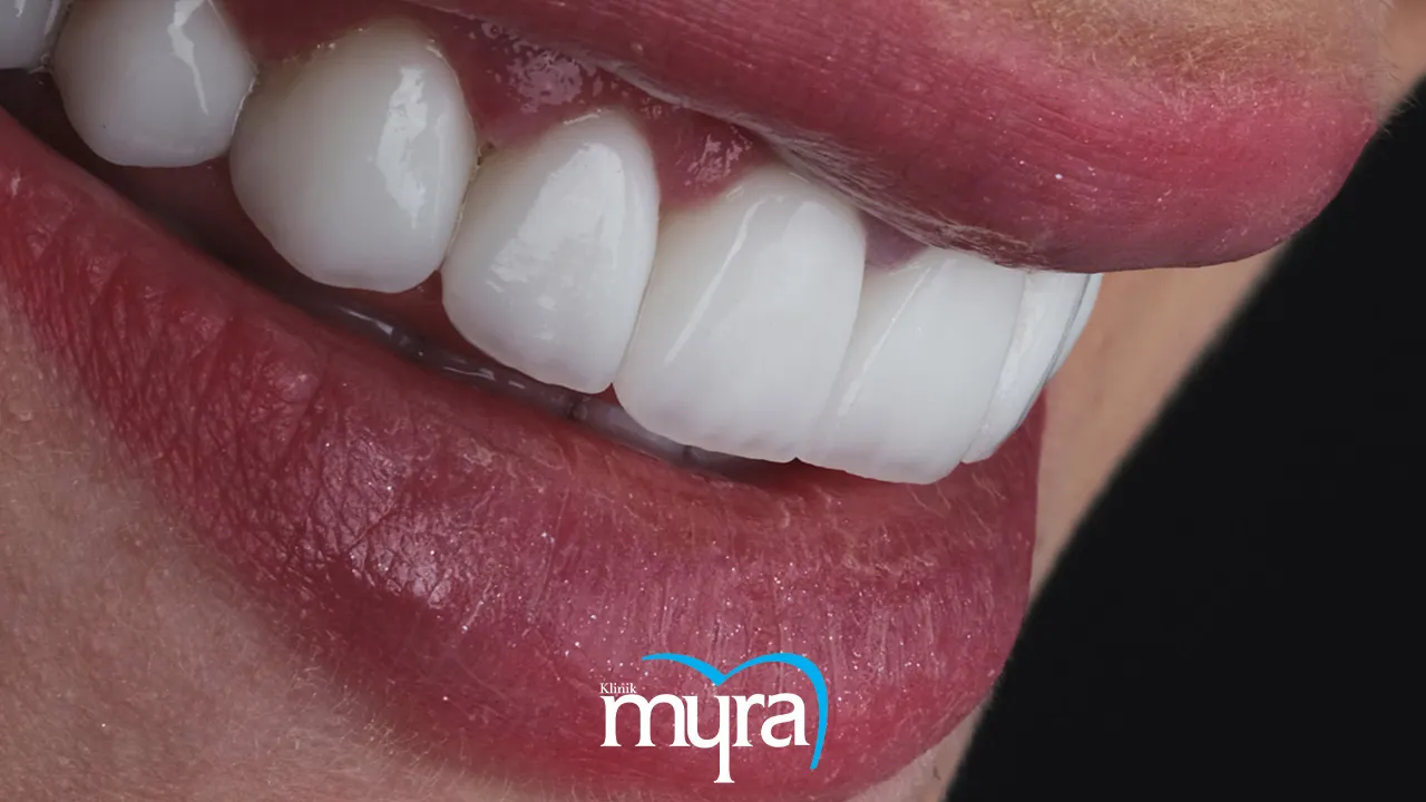 Myra Dental Centre - nasolabial-folds-definition-types-treatment-cost-and-recovery-duration