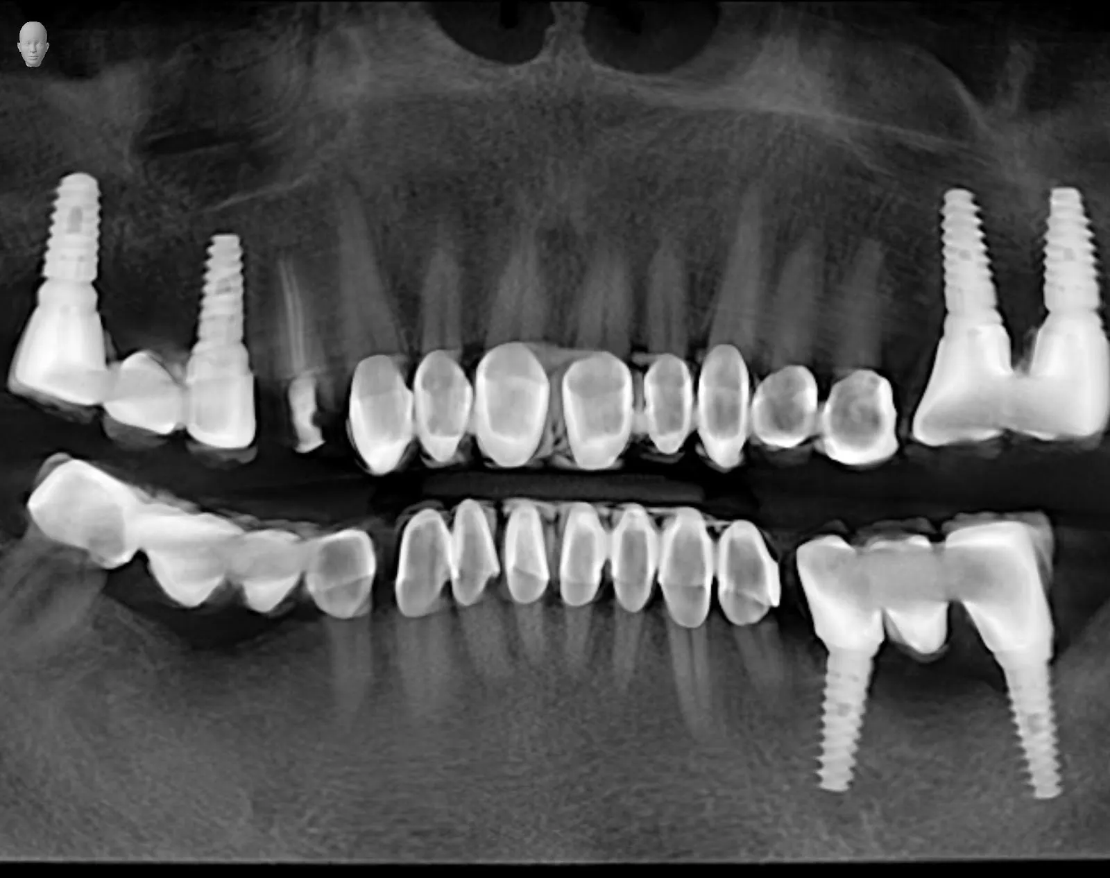 Myra Dental Centre Turkey - needs-to-know-about-dental-implants-in-turkey