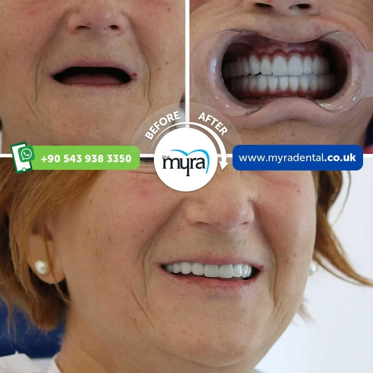 Myra Dental Centre Turkey - needs-to-know-about-dental-implants-in-turkey