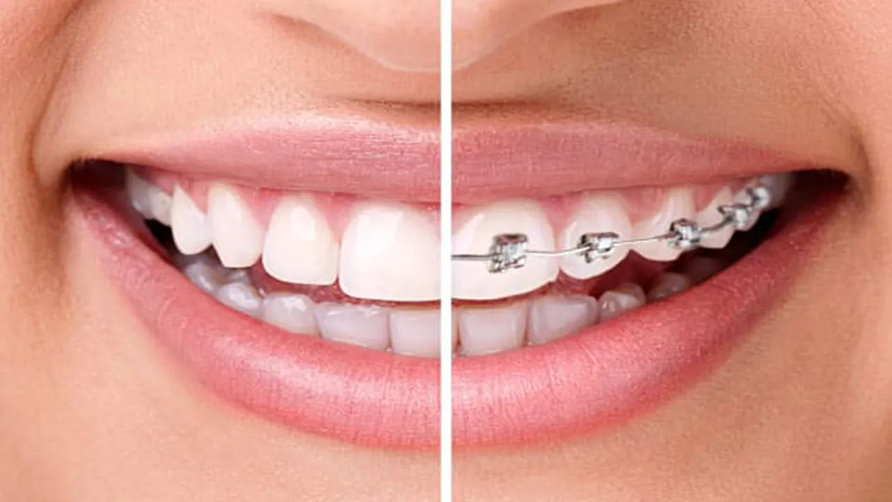 Myra Dental Centre - orthodontics-definition-types-benefits-and-cost