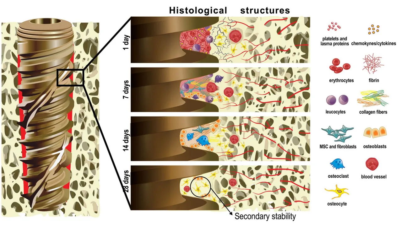 Osseointegration