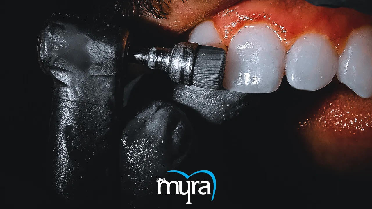 Myra Dental Centre Turkey - Brightening Dental Implants How to Whiten Dental Implant?
