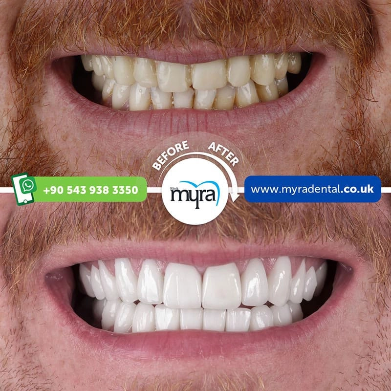 Myra Dental Centre Turkey - popular-dental-treatments-in-turkey-and-is-it-worth-it