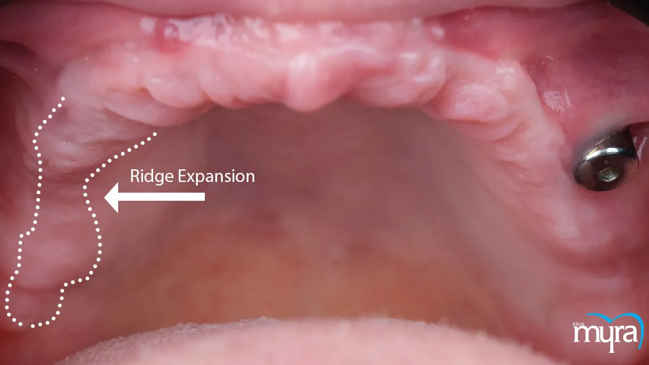 Myra Dental Centre - ridge-expansion-definition-recovery-duration-and-advantages-disadvantages