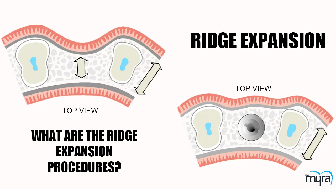Myra Dental Centre - ridge-expansion-definition-recovery-duration-and-advantages-disadvantages