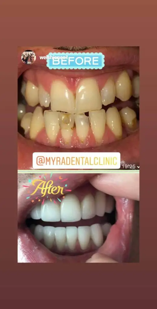 Myra Dental Centre Turkey - should-i-get-a-full-set-of-veneers-in-turkey