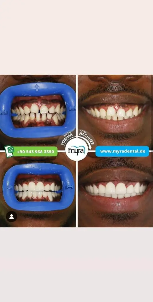 Myra Dental Centre Turkey - should-i-get-a-full-set-of-veneers-in-turkey