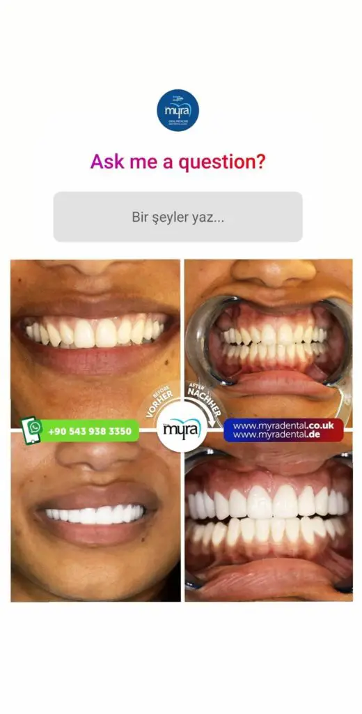 Myra Dental Centre Turkey - should-i-get-a-full-set-of-veneers-in-turkey
