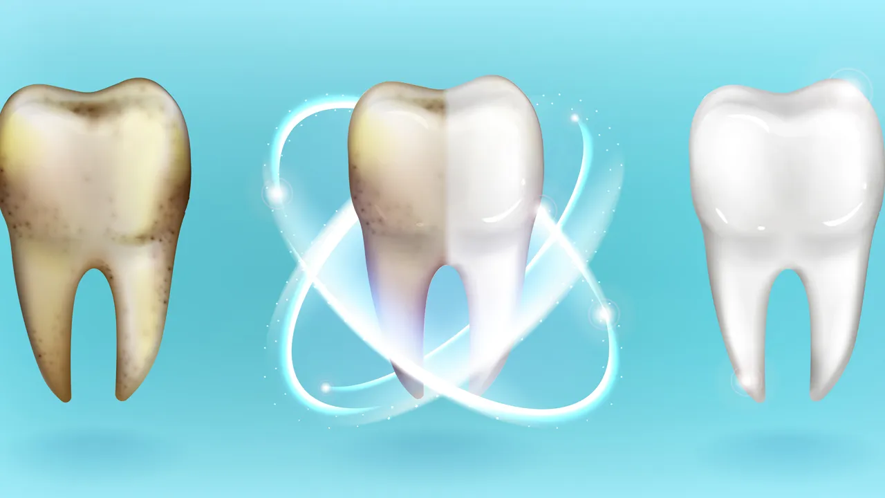 Teeth Whitening Definition