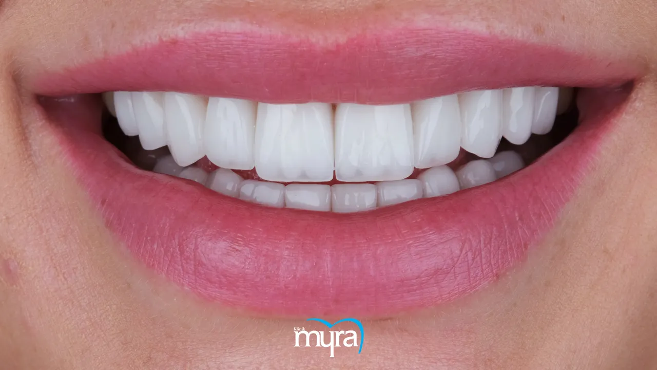 Myra Dental Centre Turkey - Typical number of veneers required for dental restoration