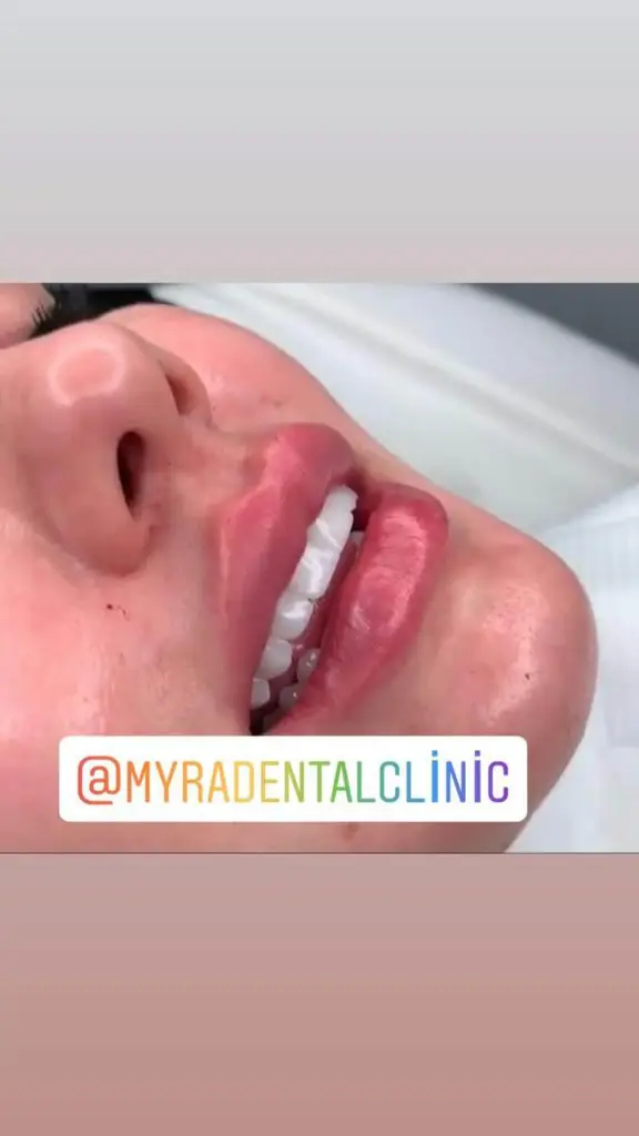 Myra Dental Centre Turkey - veneers-in-mexico-vs-turkey-prices-pros-and-cons