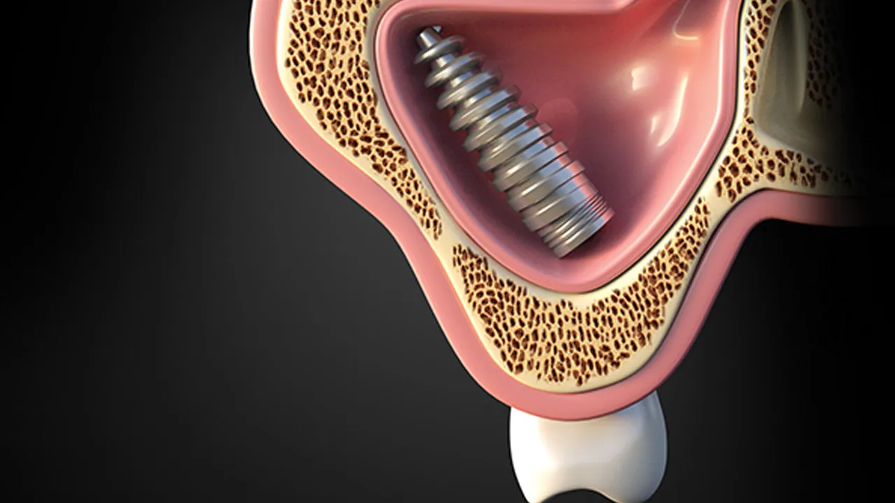 Myra Dental Centre - what-are-the-possible-side-effects-for-dental-implants