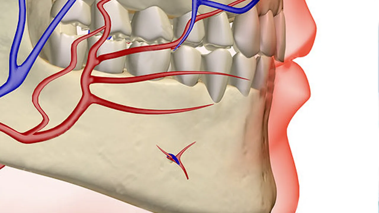 Myra Dental Centre - what-are-the-possible-side-effects-for-dental-implants