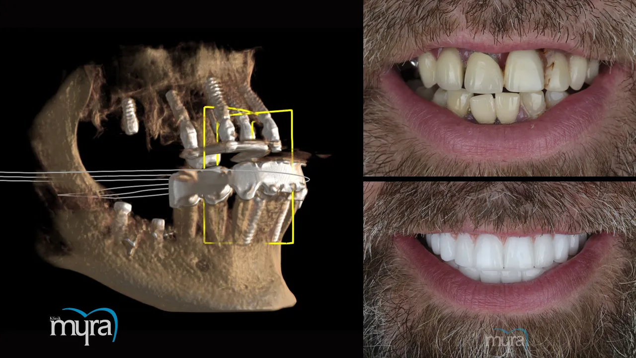 Required number of implants for supporting an upper denture