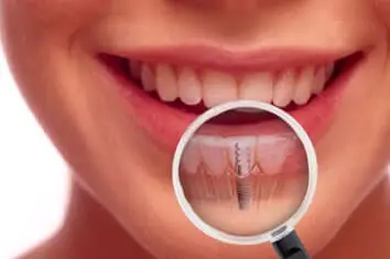 Myra Dental Centre Turkey -  what-is-dental-implant
