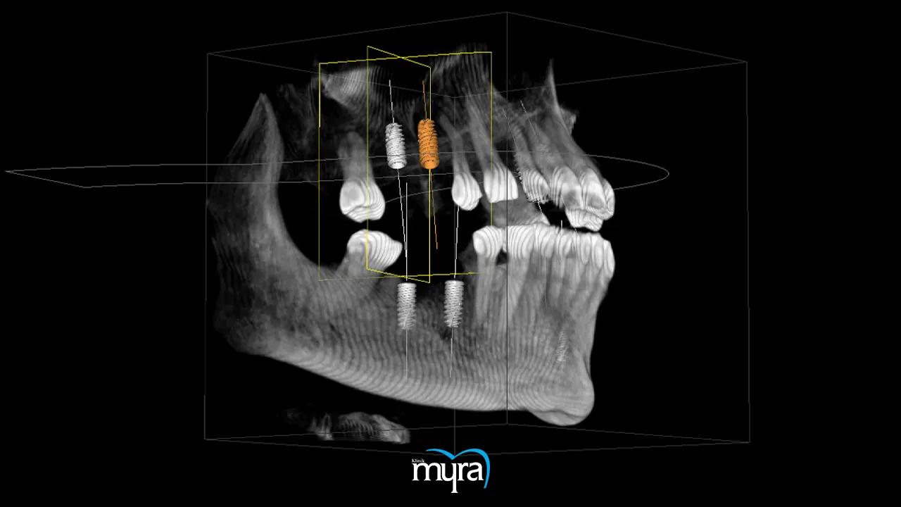 Investigating the possibility of whitening dental implants