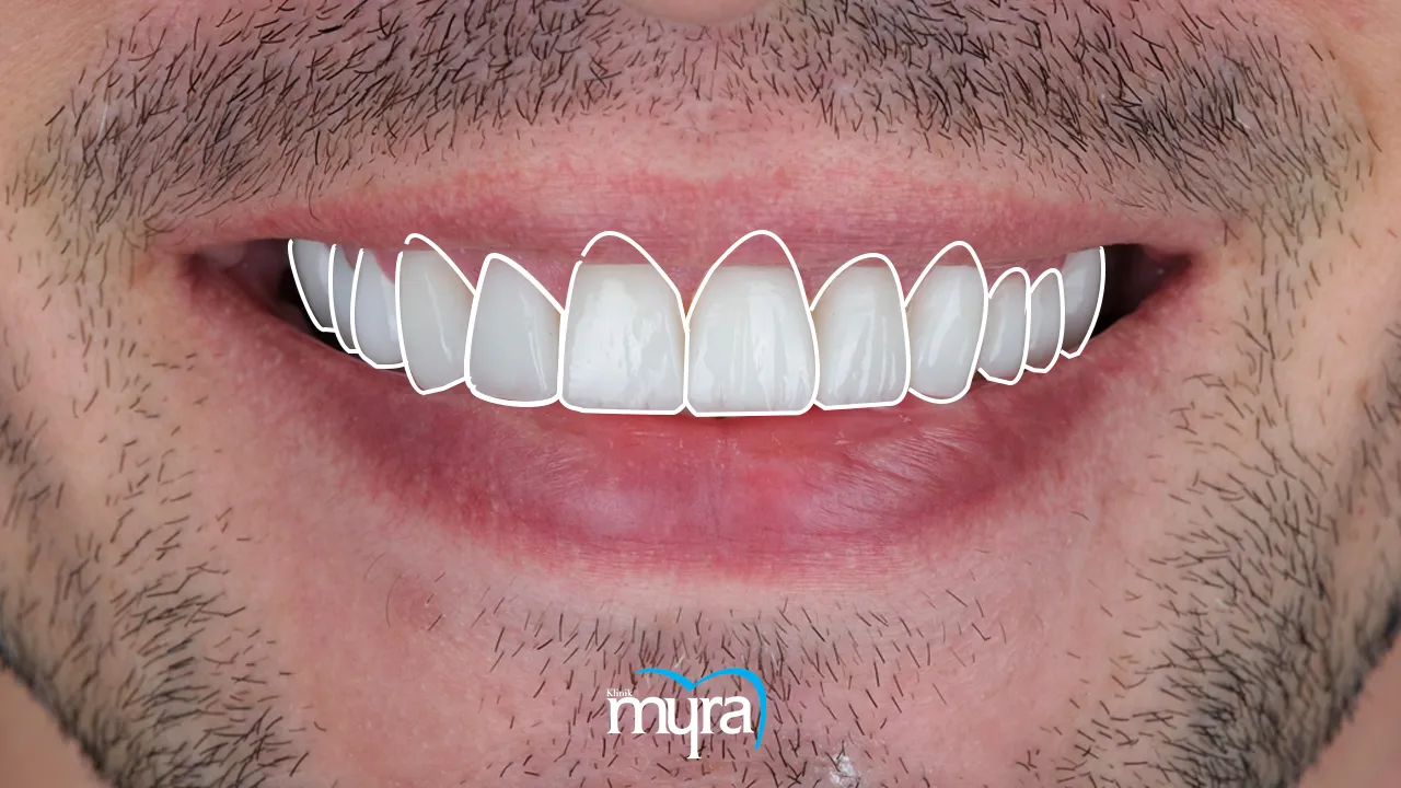 Myra Dental Centre Turkey - Typical number of veneers required for dental restoration
