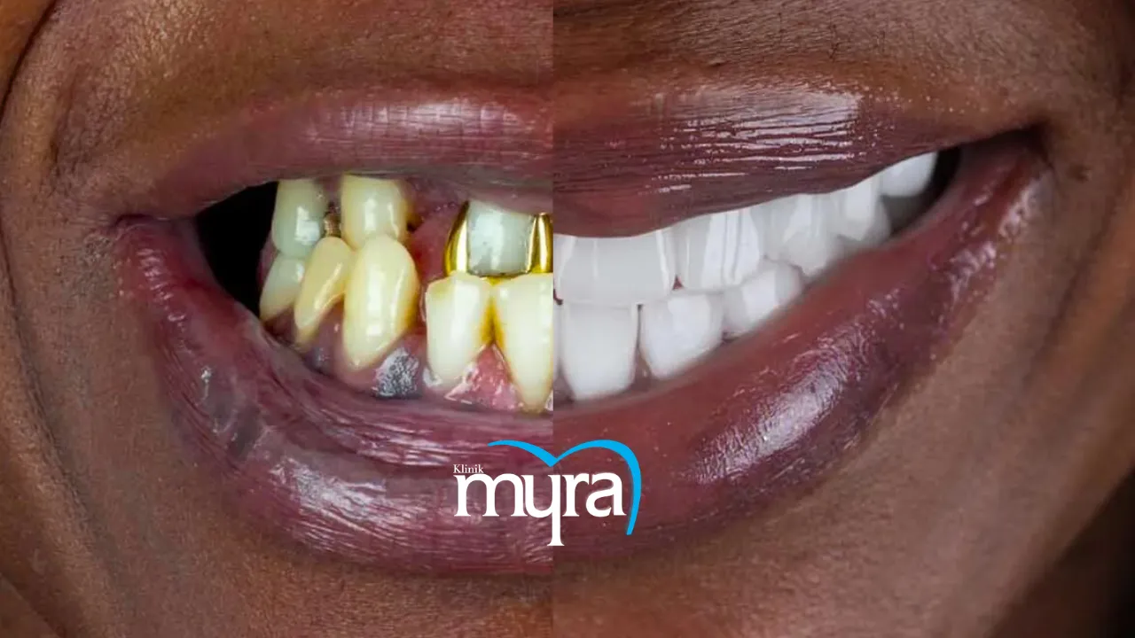 Myra Dental Centre Turkey - Ideal Interval for Implant Maintenance