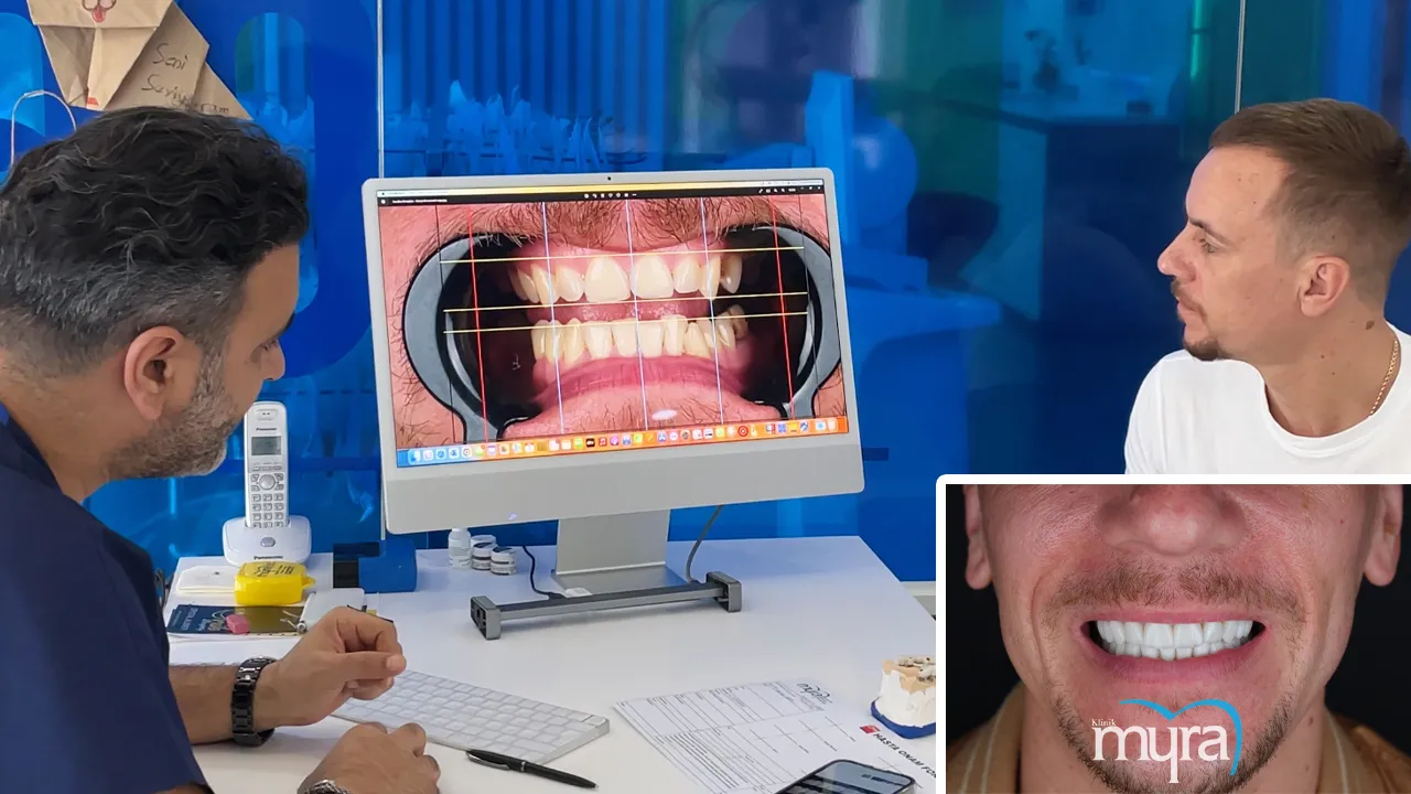 Typical number of veneers required for dental restoration