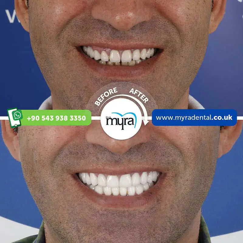 Myra Dental Centre Turkey - why-are-veneers-so-expensive