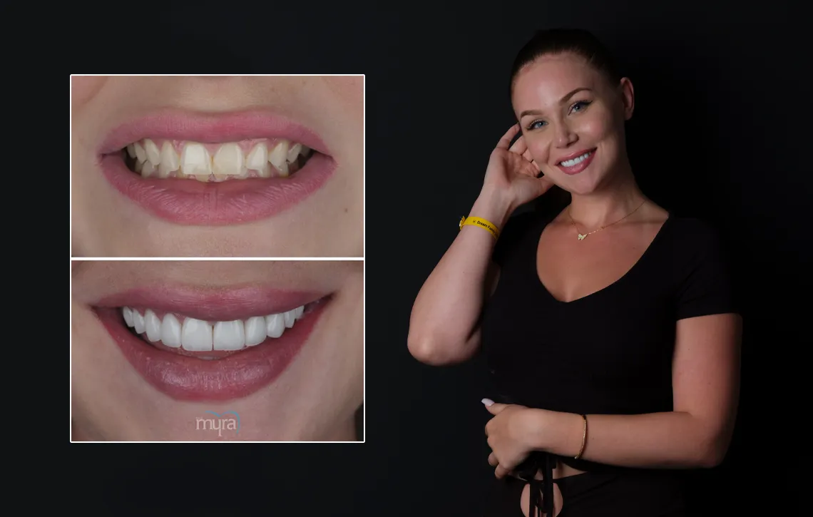 One Tip To Dramatically Improve Your composite fillings Blue Springs