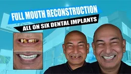 Full-mouth-reconstruction-all-on-seven-implants-with-porcelain-crowns