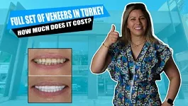 Full-set-of-veneers-in-Myra-dental-center-Turkey